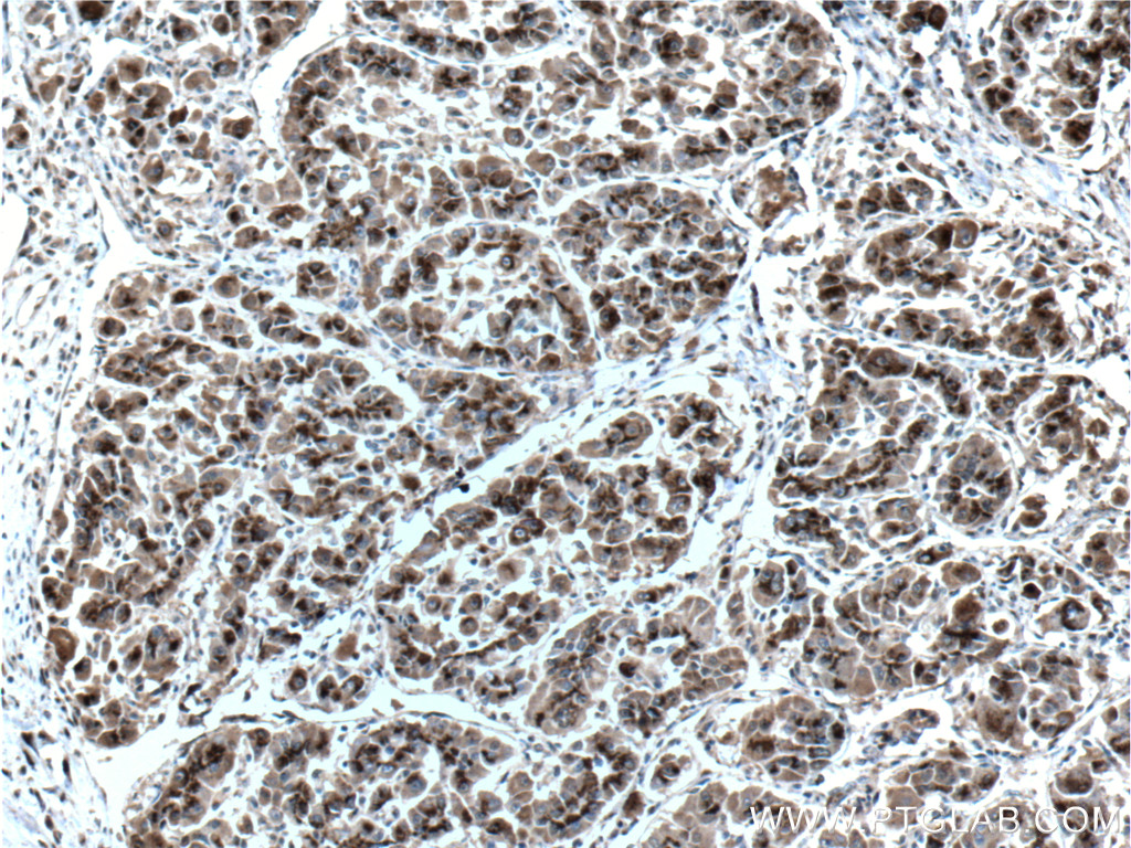 IHC staining of human liver cancer using 66331-1-Ig (same clone as 66331-1-PBS)