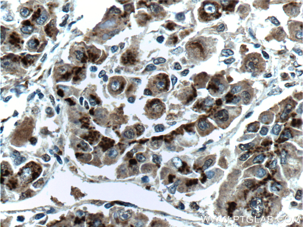 IHC staining of human liver cancer using 66331-1-Ig (same clone as 66331-1-PBS)