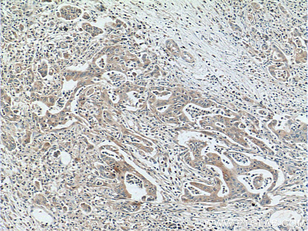 IHC staining of human pancreas cancer using 16700-1-AP