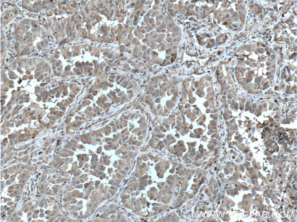 IHC staining of human lung cancer using 15171-1-AP