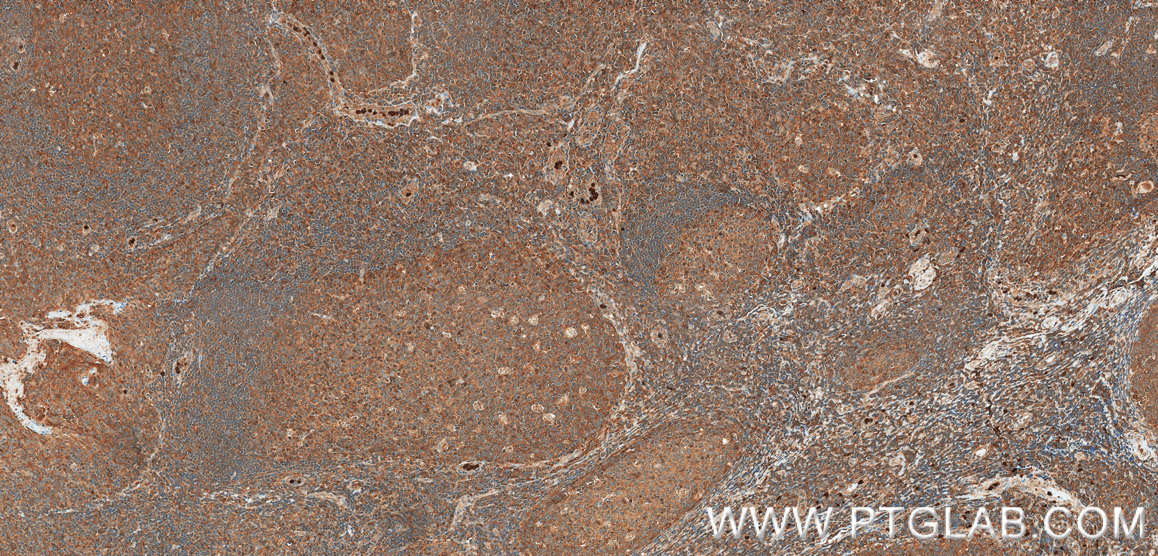 IHC staining of human tonsil using 98942-1-RR IHC staining of human tonsil using 98942-1-RR