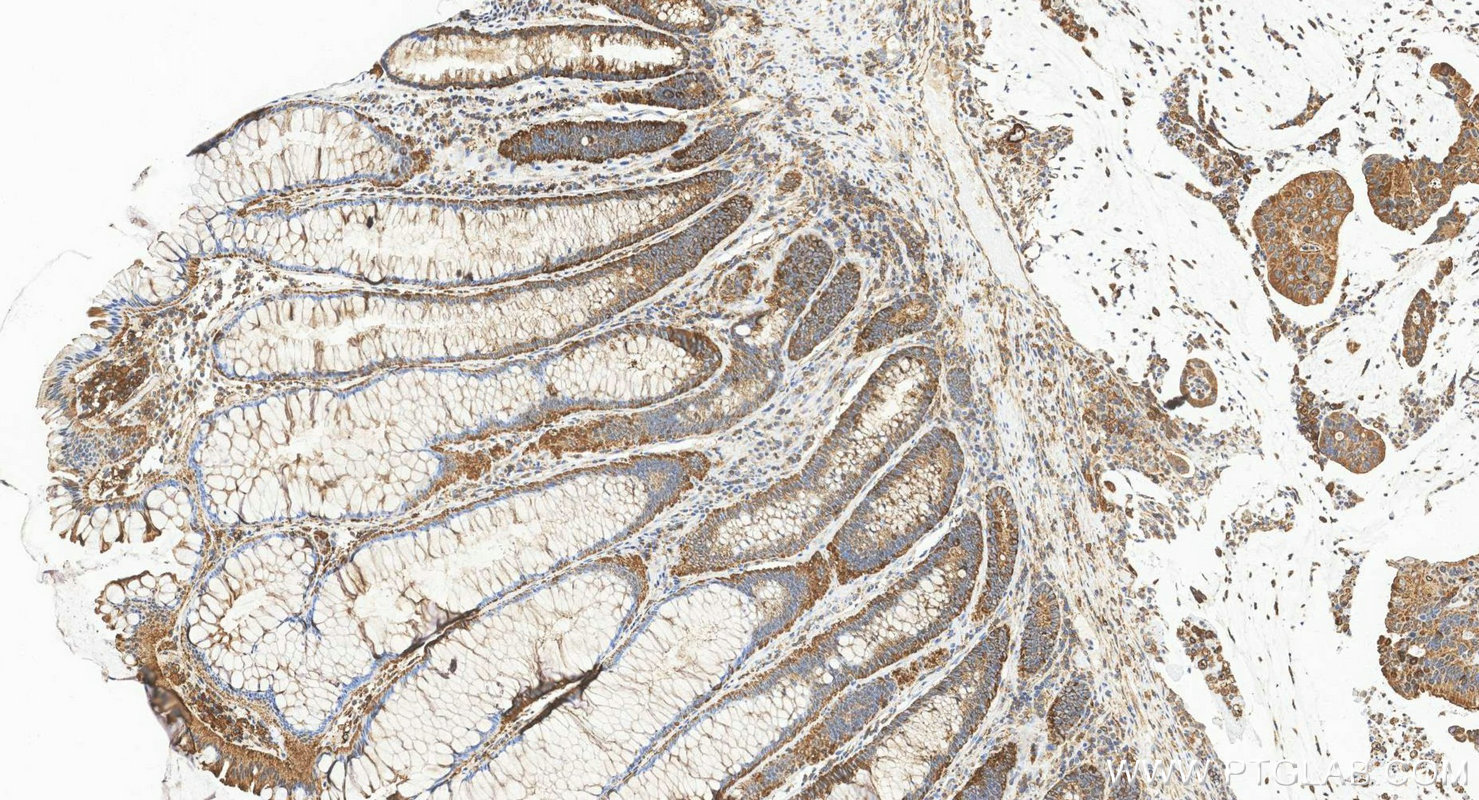 IHC staining of human colon cancer using 84160-3-RR (same clone as 84160-3-PBS) IHC staining of human colon cancer using 84160-3-RR (same clone as 84160-3-PBS)