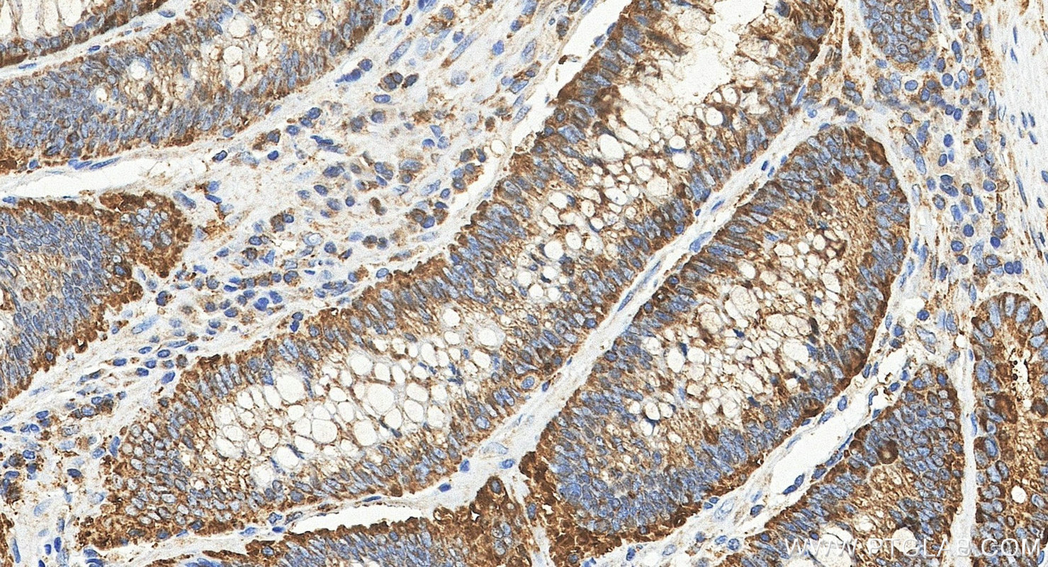 IHC staining of human colon cancer using 84160-3-RR (same clone as 84160-3-PBS) IHC staining of human colon cancer using 84160-3-RR (same clone as 84160-3-PBS)