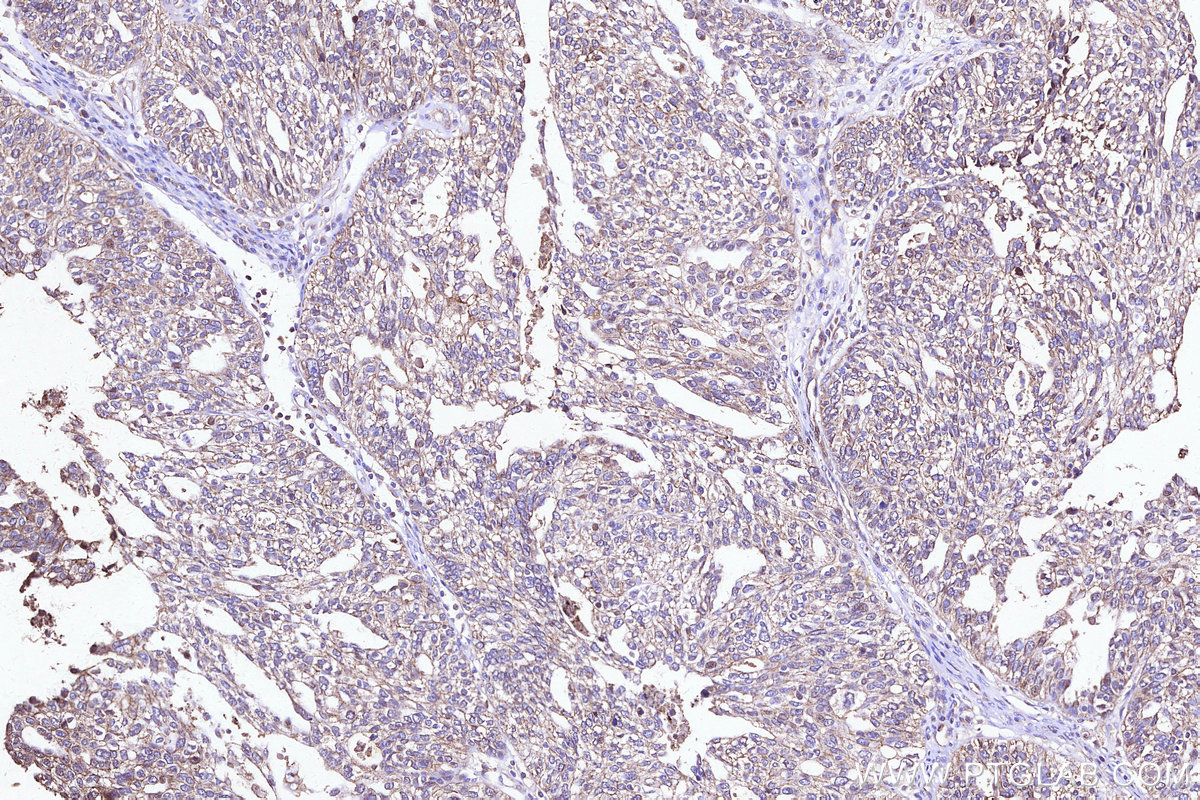 IHC staining of human ovary cancer using 33499-1-AP IHC staining of human ovary cancer using 33499-1-AP