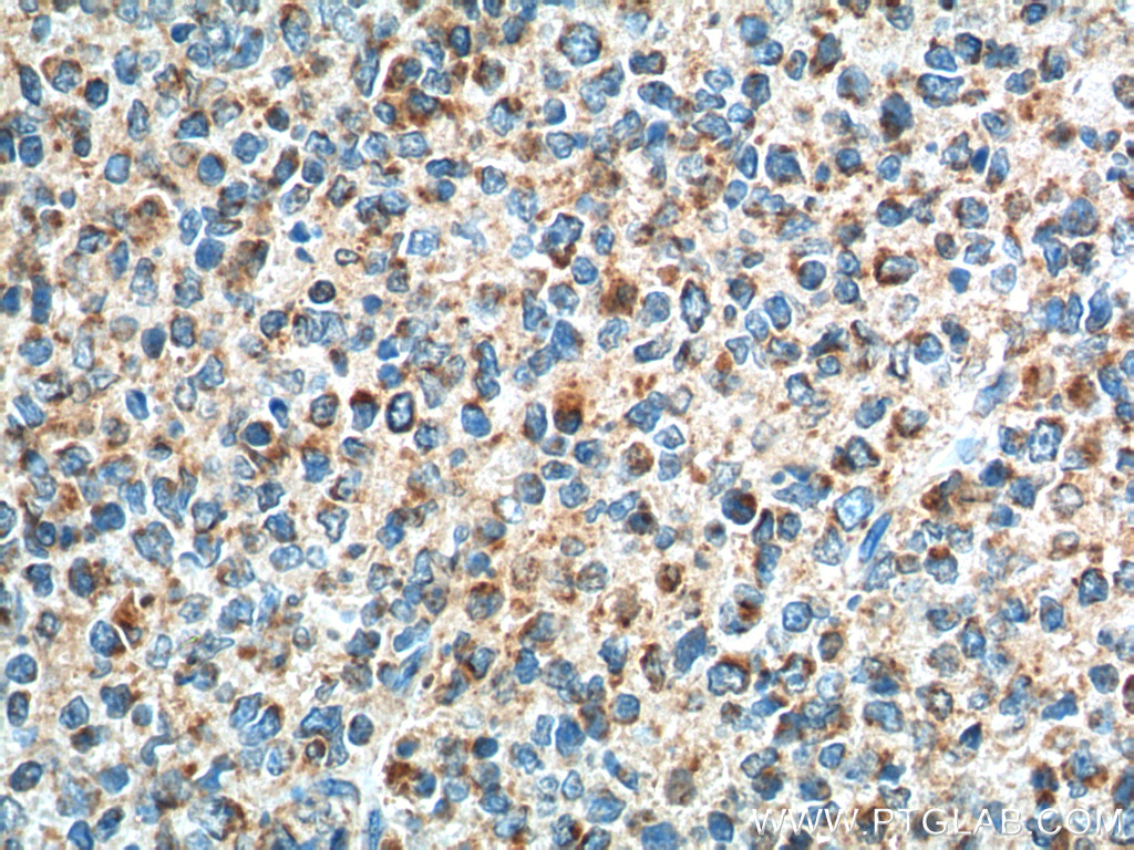 IHC staining of human tonsillitis using 20306-1-AP