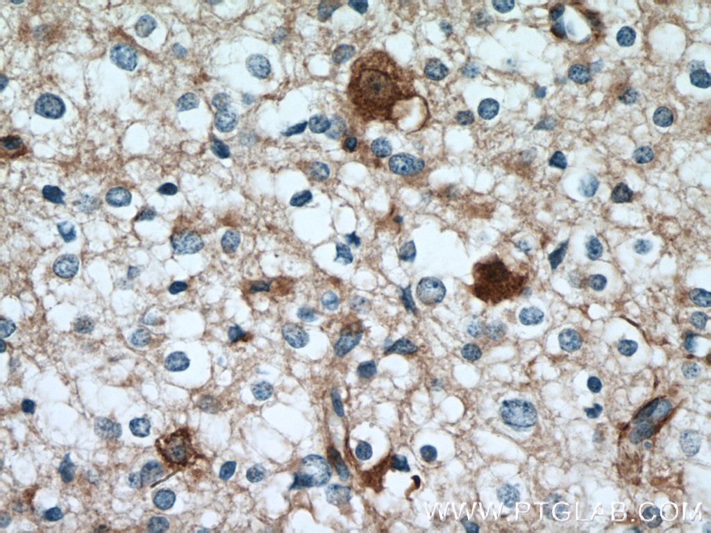 IHC staining of human gliomas using 12159-1-AP
