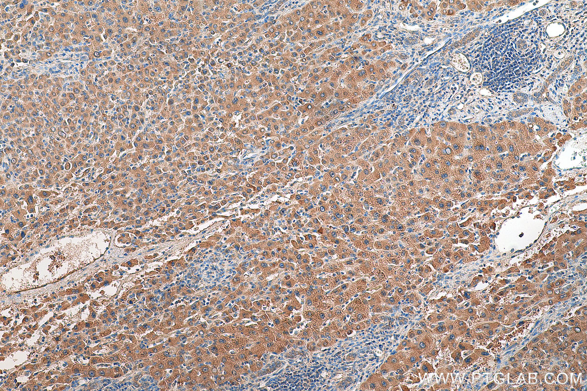 IHC staining of human liver cancer using 13501-1-AP