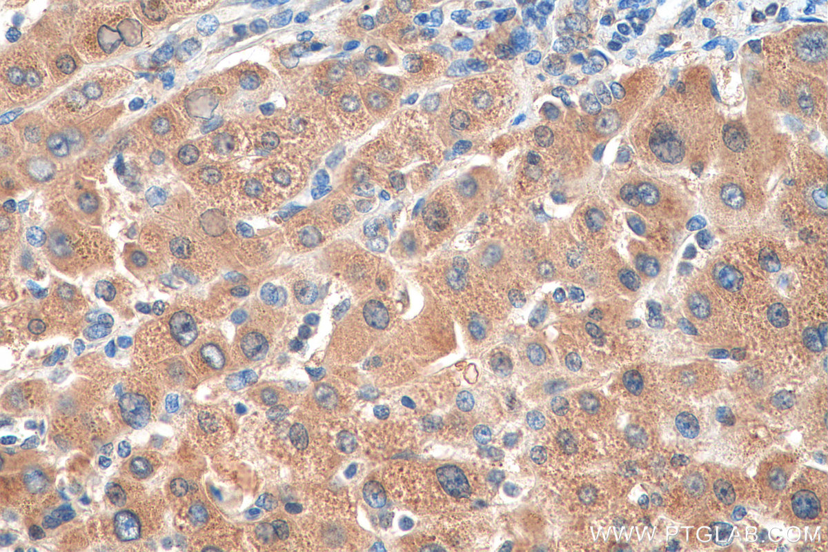 IHC staining of human liver cancer using 13501-1-AP