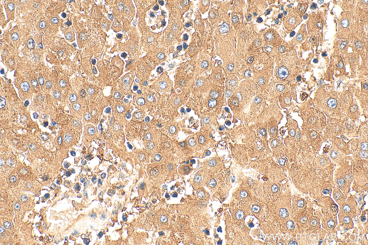 IHC staining of human liver cancer using 24299-1-AP IHC staining of human liver cancer using 24299-1-AP