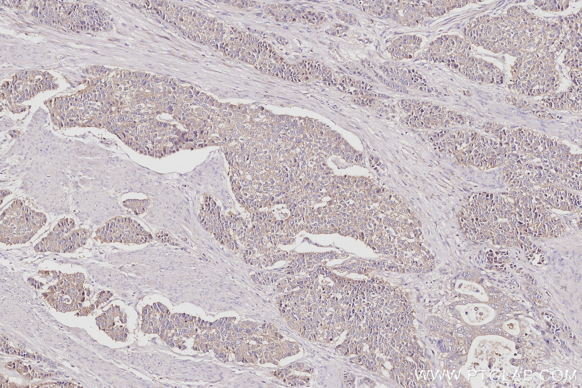 IHC staining of human stomach cancer using 10747-2-AP IHC staining of human stomach cancer using 10747-2-AP