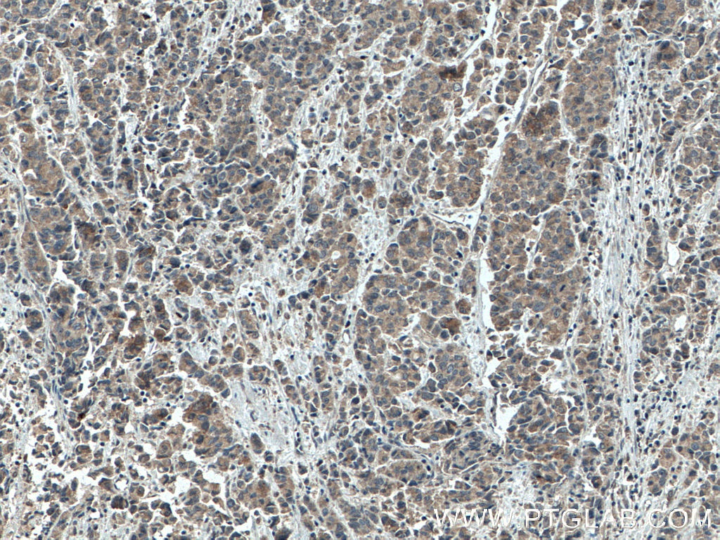 IHC staining of human prostate cancer using 66651-1-Ig (same clone as 66651-1-PBS)