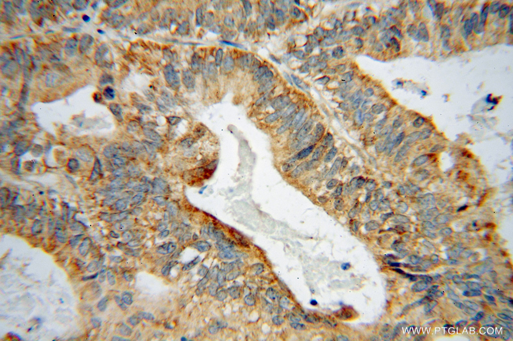 IHC staining of human ovary tumor using 15298-1-AP