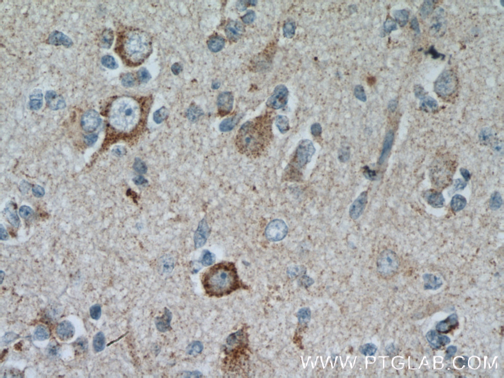 IHC staining of human gliomas using 13040-1-AP