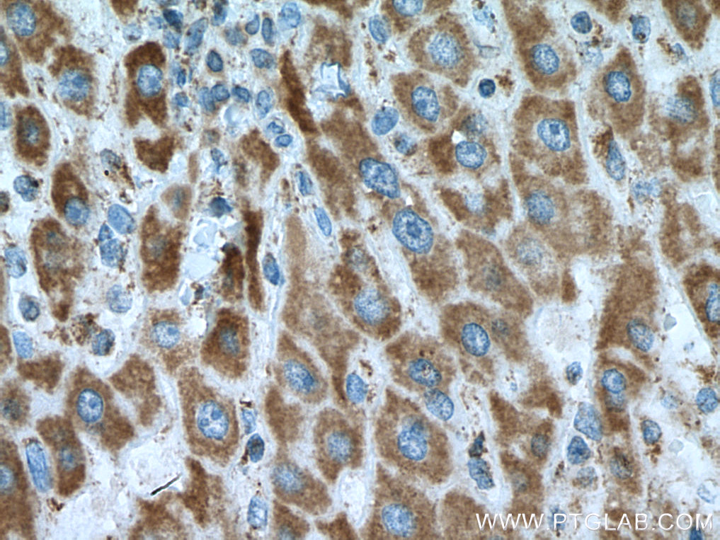 IHC staining of human liver cancer using 67414-1-Ig (same clone as 67414-1-PBS)