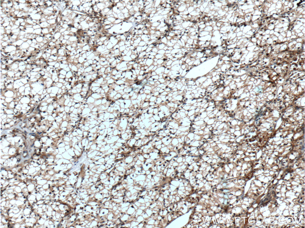 IHC staining of human renal cell carcinoma using 11439-1-AP