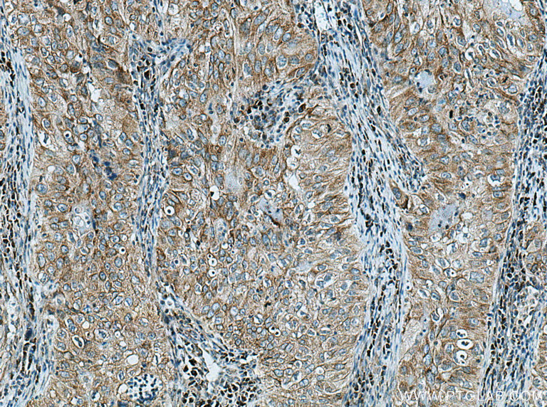 IHC staining of human lung cancer using 28482-1-AP