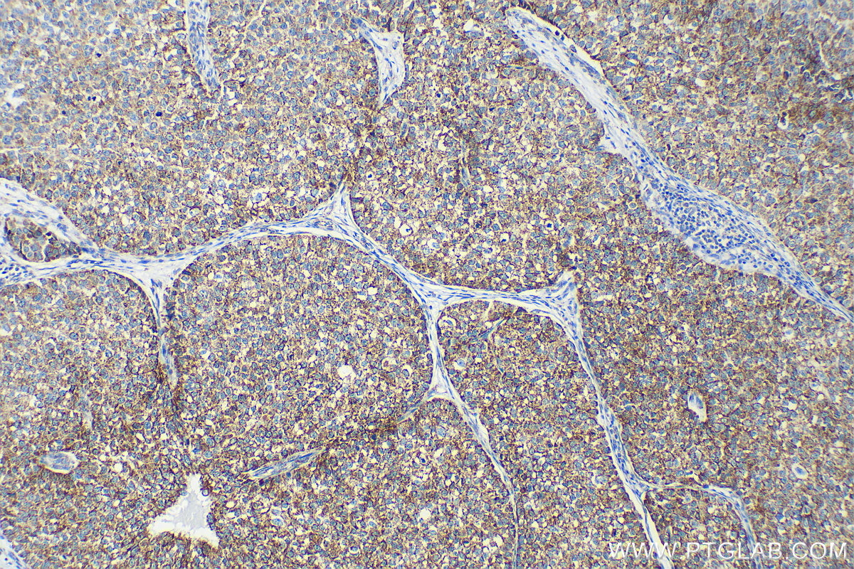 IHC staining of human breast cancer using 67563-1-Ig