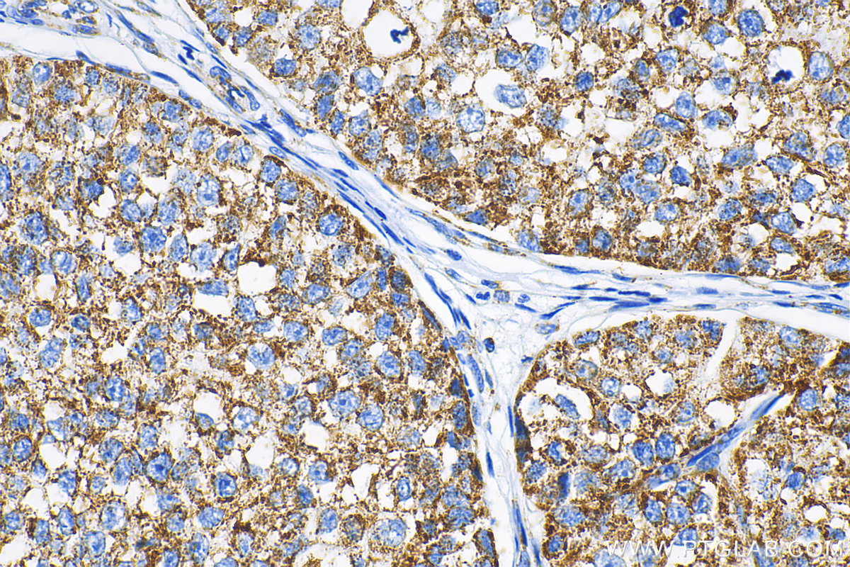 IHC staining of human breast cancer using 67563-1-Ig