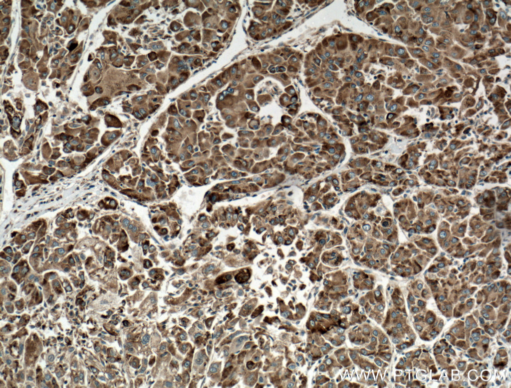 IHC staining of human liver cancer using 66574-1-Ig (same clone as 66574-1-PBS)