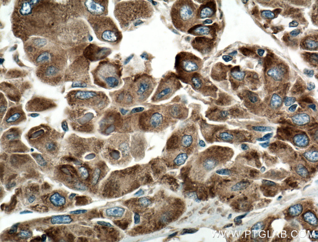 IHC staining of human liver cancer using 66574-1-Ig (same clone as 66574-1-PBS)
