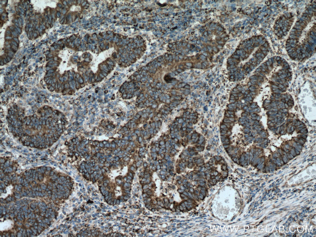 IHC staining of human colon cancer using 60012-2-Ig (same clone as 60012-2-PBS)