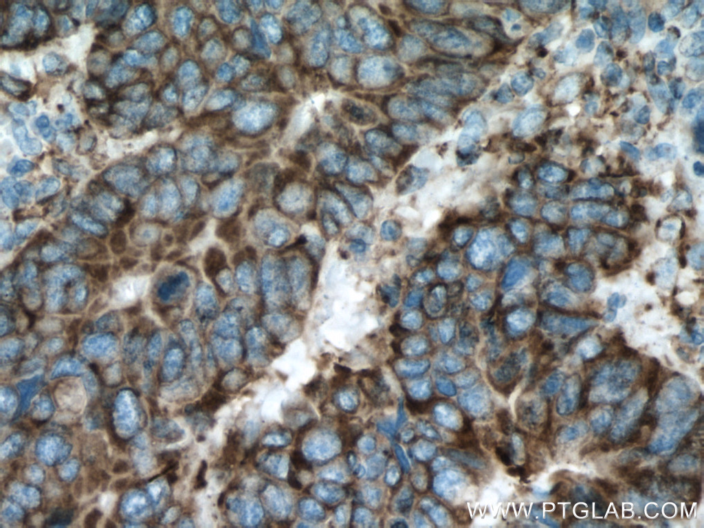 IHC staining of human colon cancer using 60012-2-Ig (same clone as 60012-2-PBS)