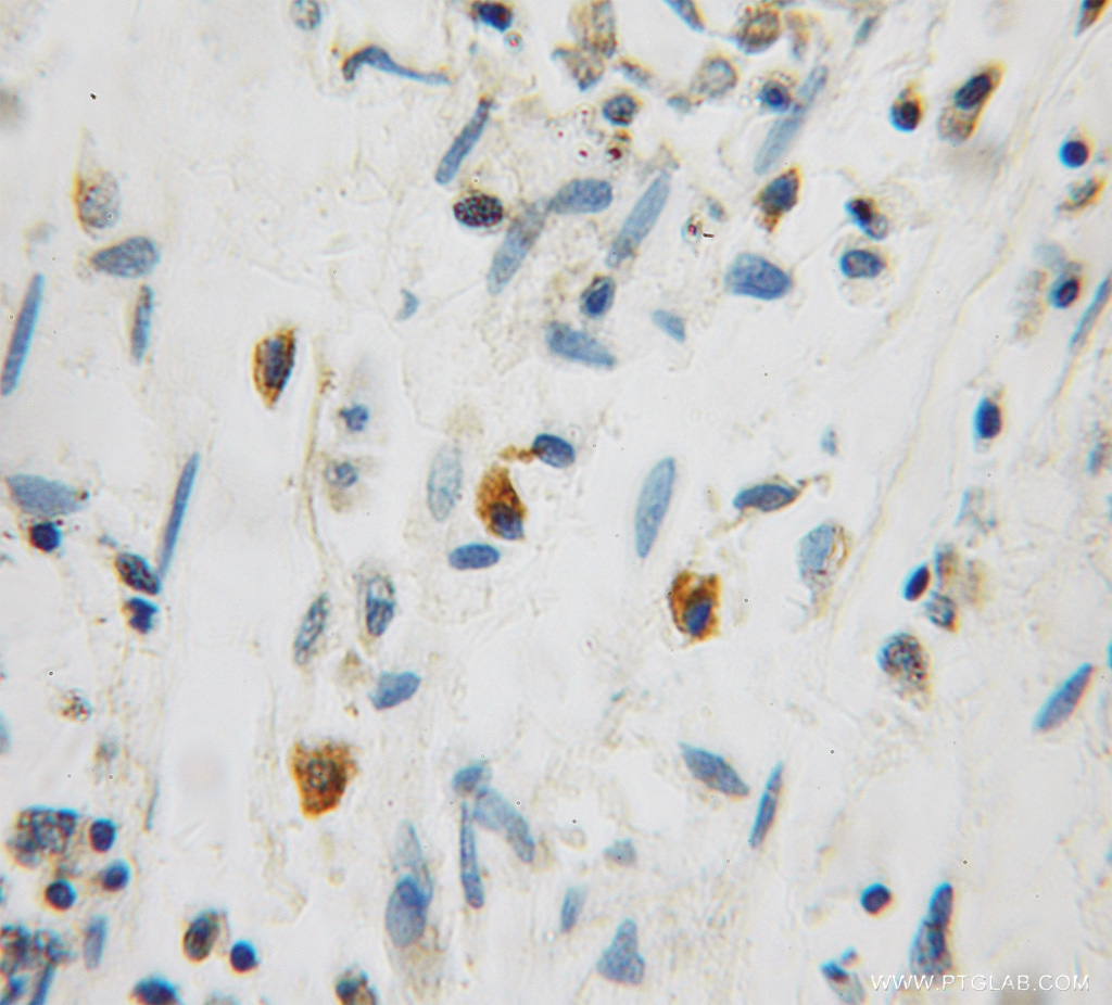 IHC staining of human colon cancer using 12720-1-AP