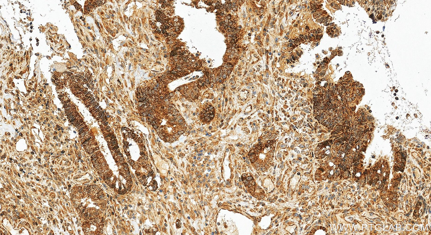 IHC staining of human colon cancer using 30992-1-AP