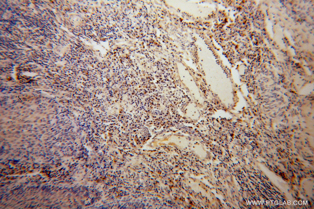 IHC staining of human cervical cancer using 14163-1-AP