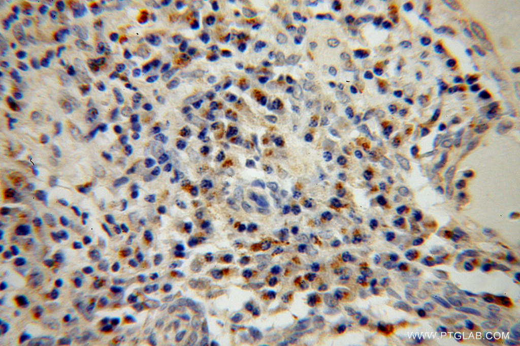 IHC staining of human cervical cancer using 14163-1-AP