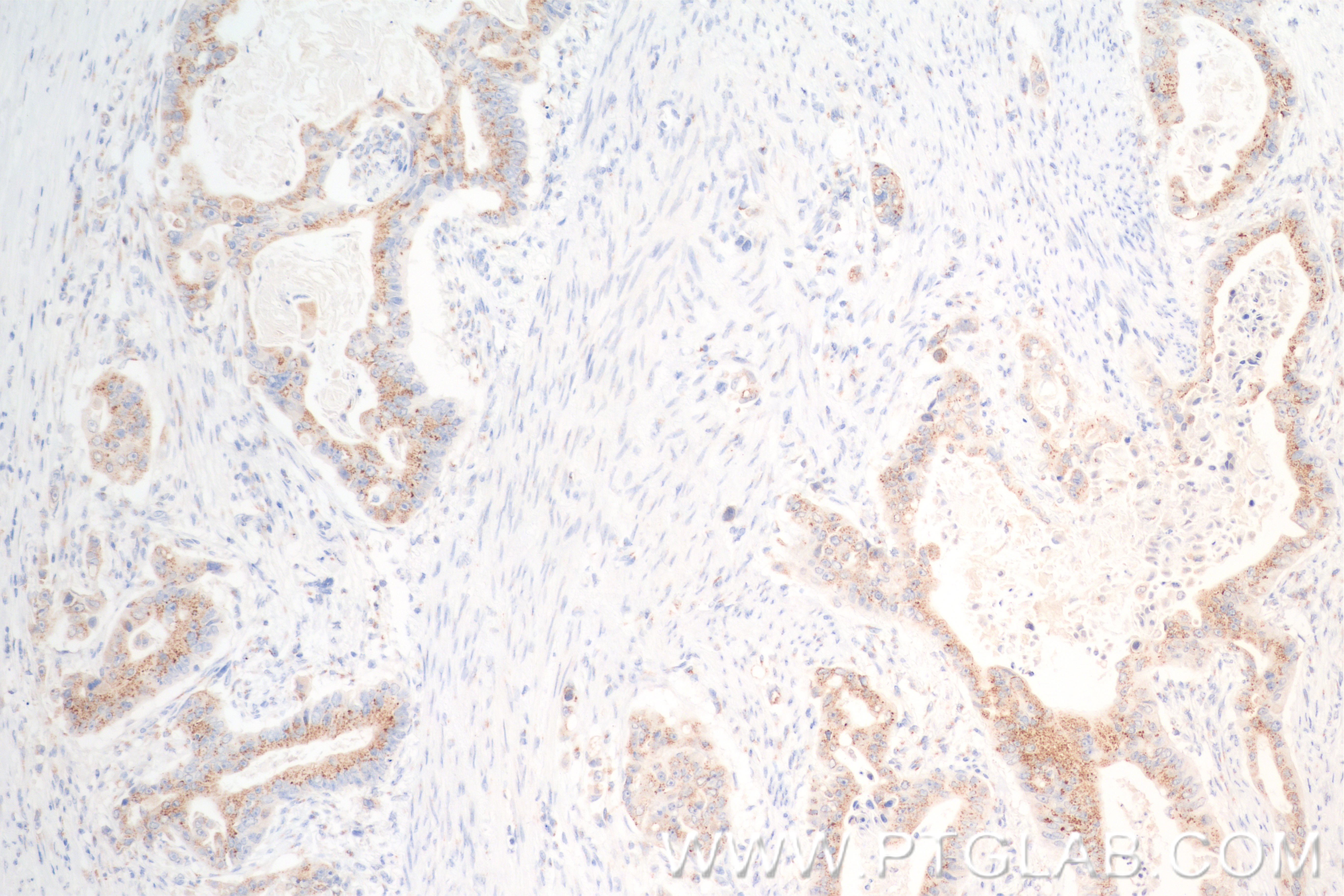IHC staining of human stomach cancer using 84971-3-RR (same clone as 84971-3-PBS)