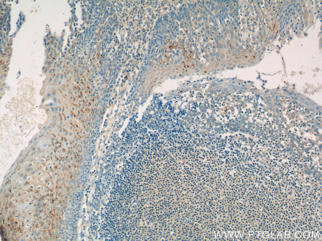 IHC staining of human tonsillitis using 17328-1-AP