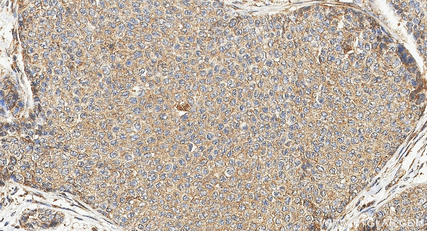 IHC staining of human breast cancer using 51065-1-AP IHC staining of human breast cancer using 51065-1-AP
