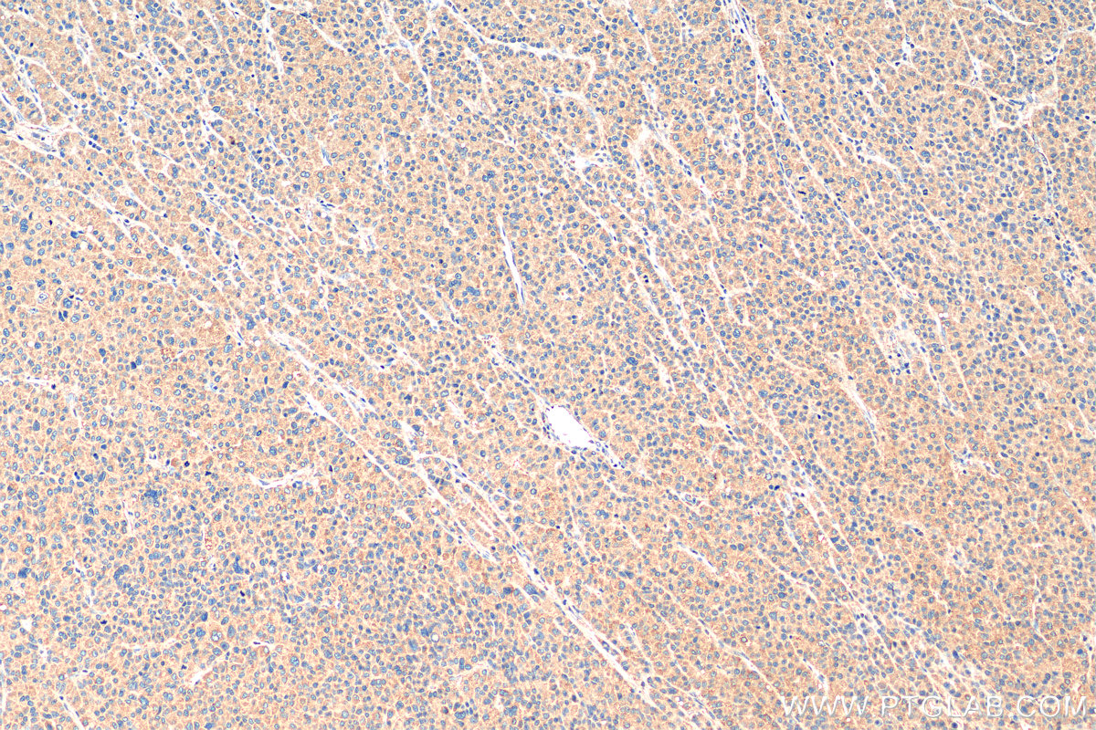 IHC staining of human liver cancer using 10763-1-AP