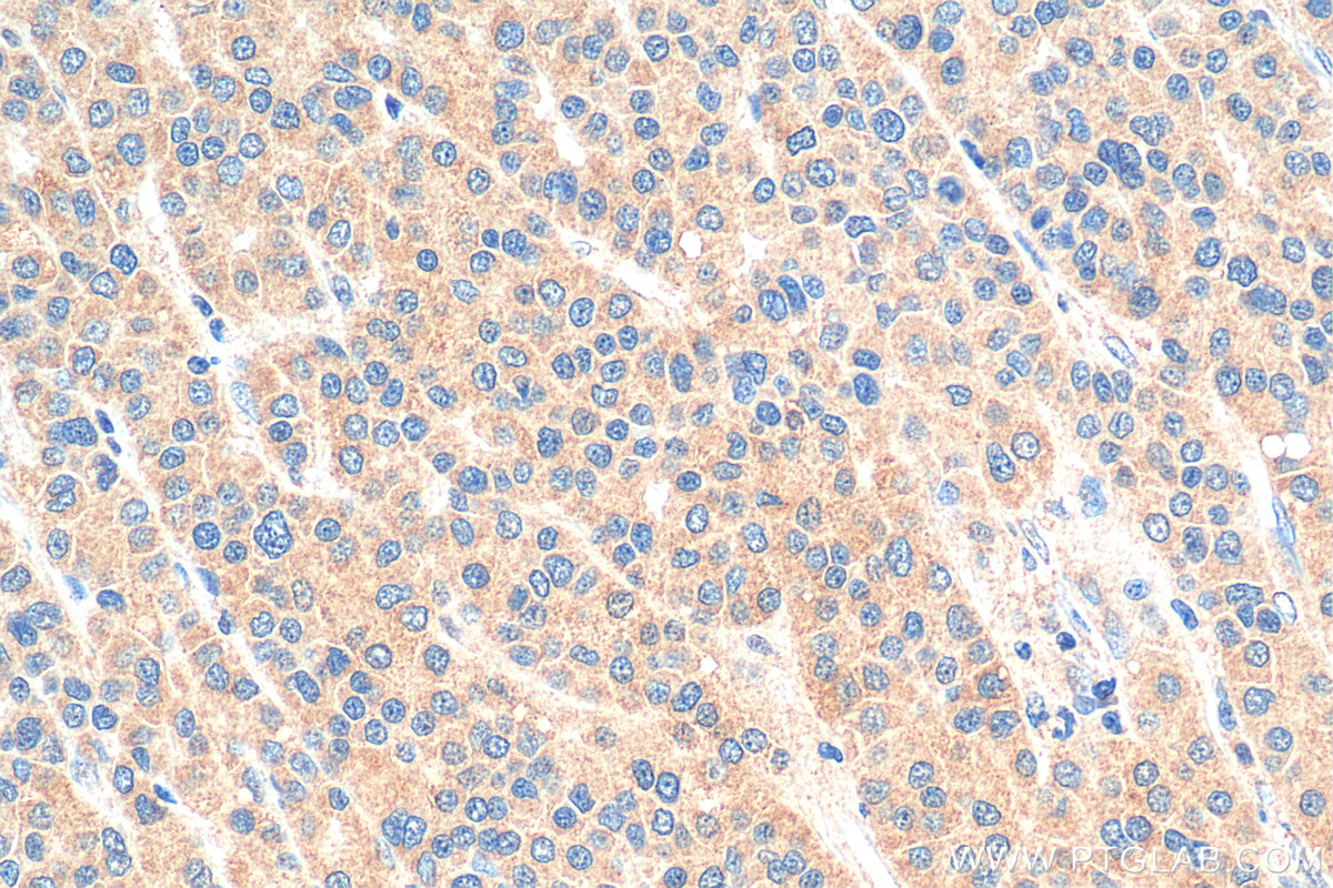 IHC staining of human liver cancer using 10763-1-AP