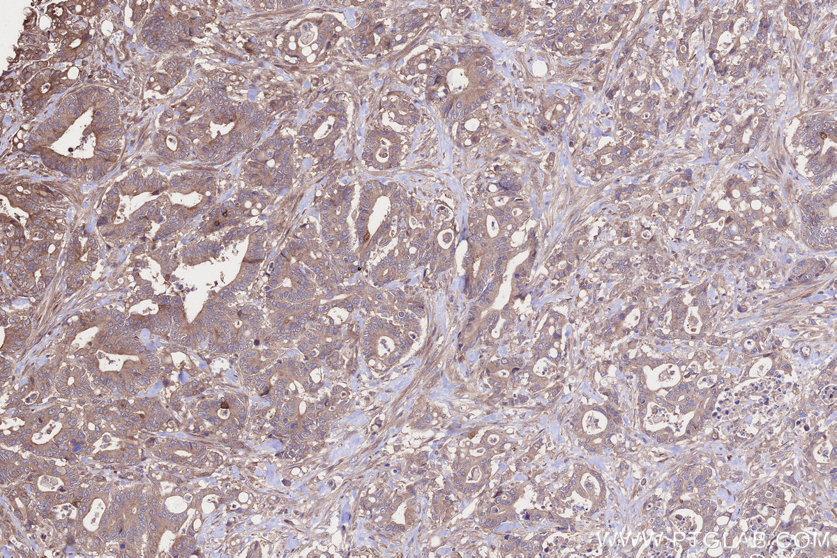 IHC staining of human rectal cancer using 12989-1-AP IHC staining of human rectal cancer using 12989-1-AP