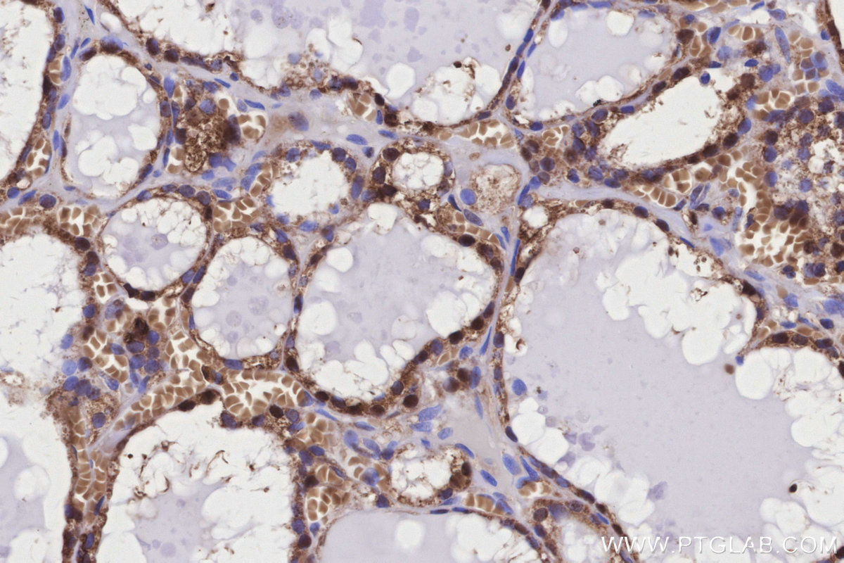 IHC staining of human thyroid cancer using 84480-2-RR IHC staining of human thyroid cancer using 84480-2-RR