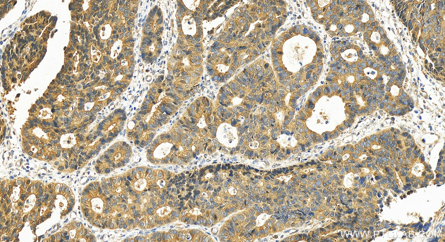 IHC staining of human stomach cancer using 55474-1-AP