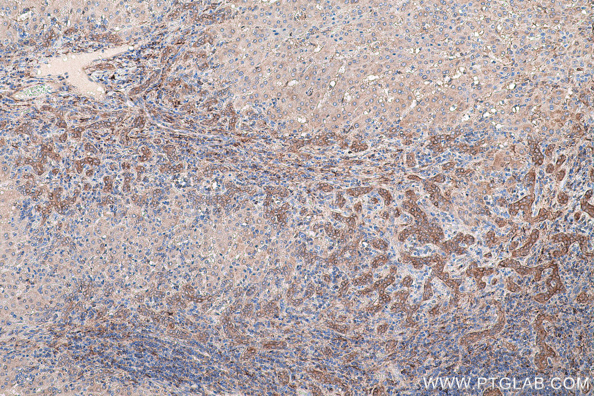 IHC staining of human liver cancer using 67634-1-Ig (same clone as 67634-1-PBS) IHC staining of human liver cancer using 67634-1-Ig (same clone as 67634-1-PBS)