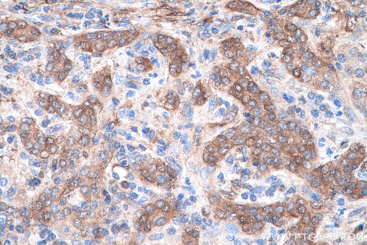 IHC staining of human liver cancer using 67634-1-Ig (same clone as 67634-1-PBS) IHC staining of human liver cancer using 67634-1-Ig (same clone as 67634-1-PBS)
