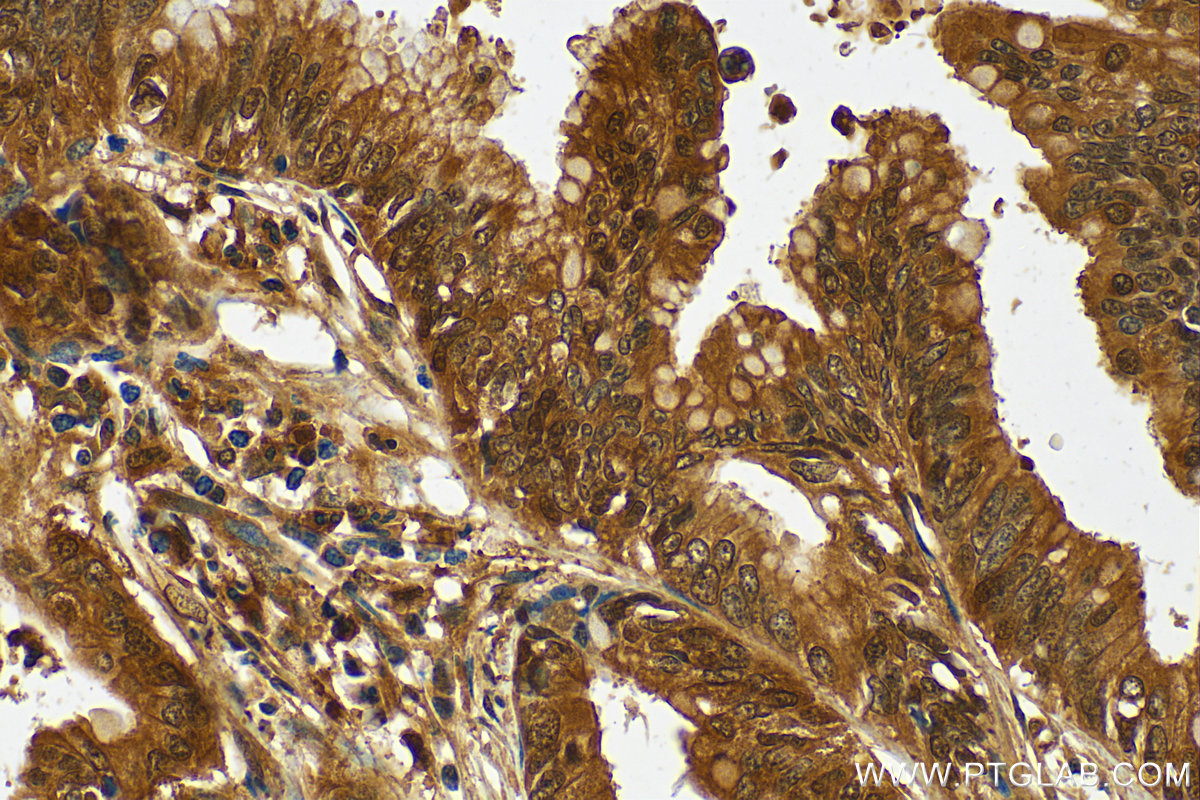 IHC staining of human pancreas cancer using 15124-1-AP