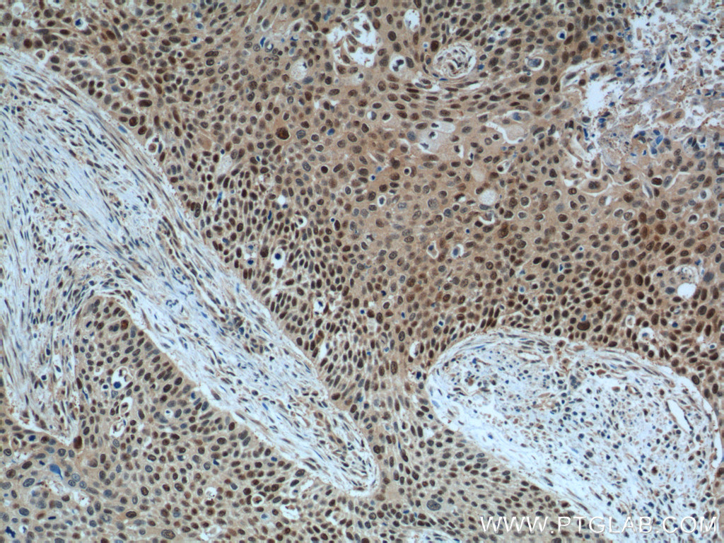 IHC staining of human oesophagus cancer using 60150-2-Ig (same clone as 60150-2-PBS)