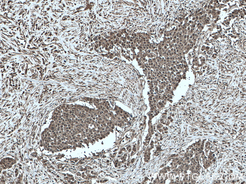 IHC staining of human colon cancer using 66715-1-Ig (same clone as 66715-1-PBS)