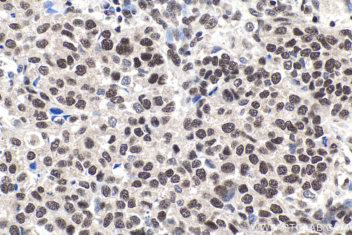 IHC staining of human stomach cancer using 24405-1-AP