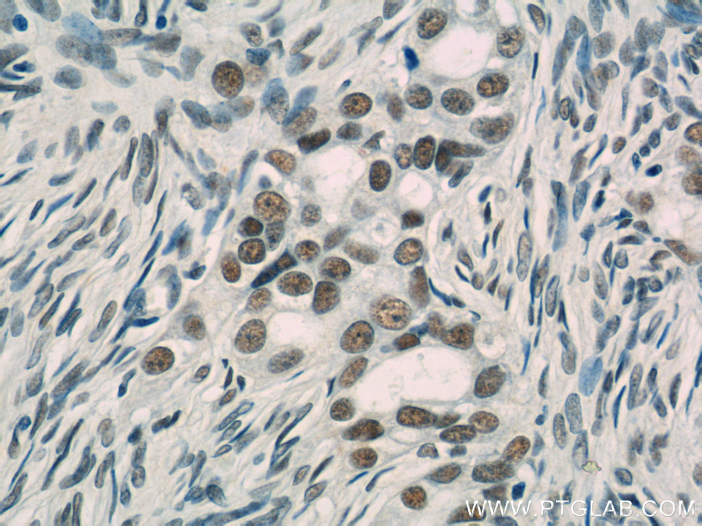IHC staining of human ovary tumor using 10499-1-AP
