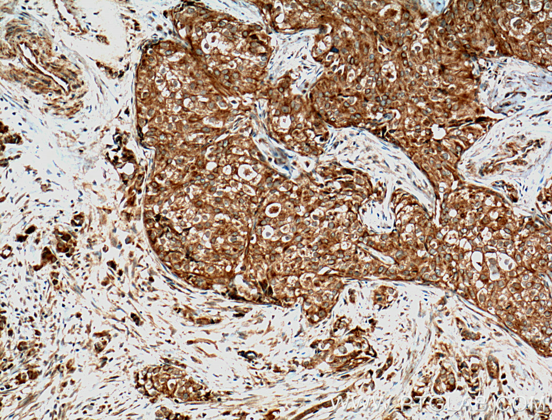 IHC staining of human breast cancer using 10764-1-AP