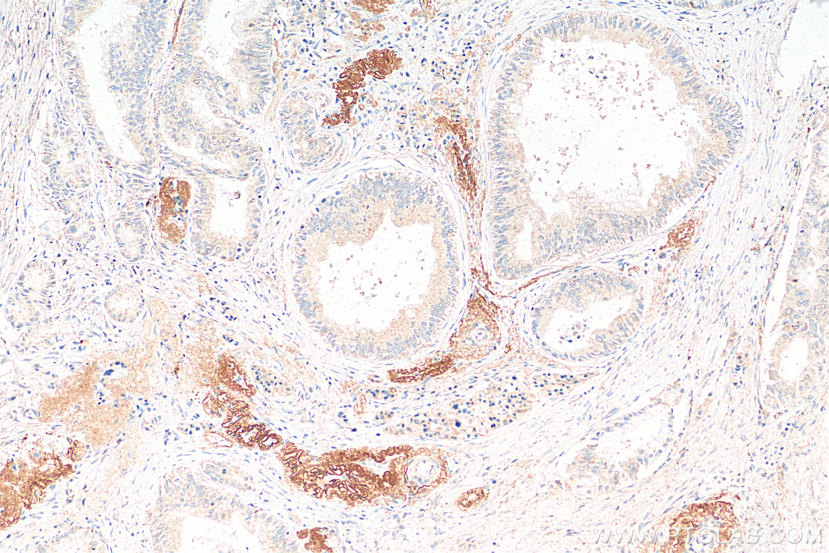IHC staining of human pancreas cancer using 18113-1-AP