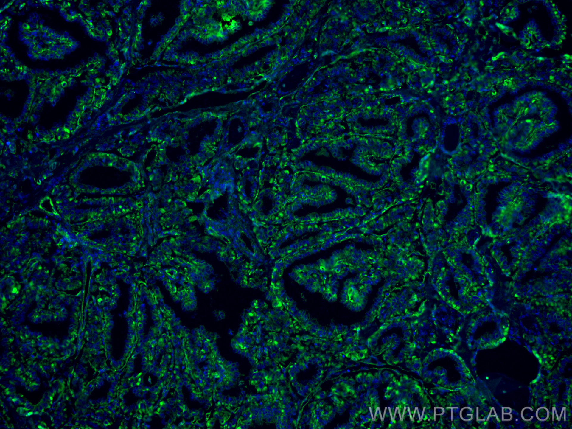 IF Staining of human thyroid cancer using 67047-1-Ig