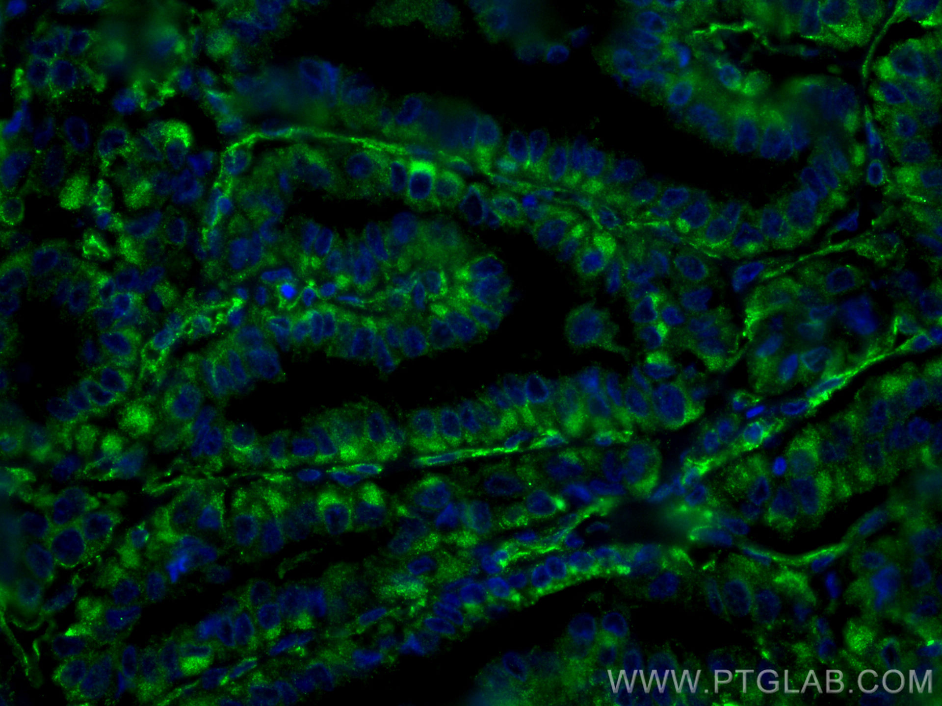 IF Staining of human thyroid cancer using 67047-1-Ig