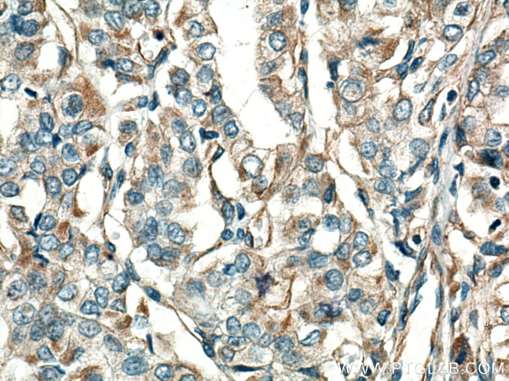 IHC staining of human thyroid cancer using 67047-1-Ig